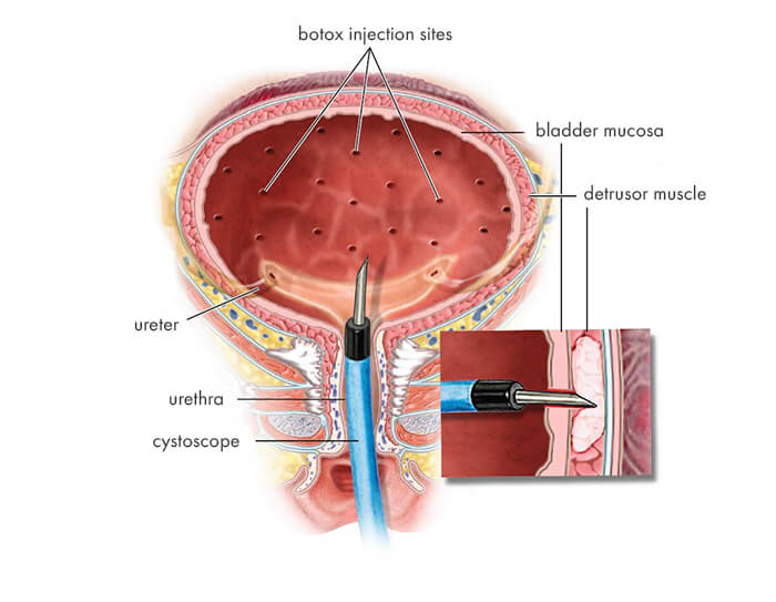 Botox for Overactive Bladder – Everything You Need to Know
