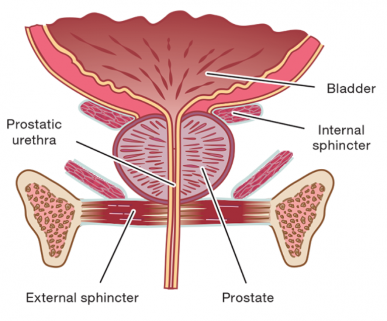 Urine leakage after prostate cancer surgery